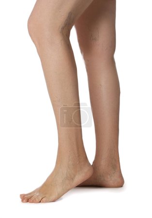 Photo for Closeup view of woman with varicose veins on white background - Royalty Free Image