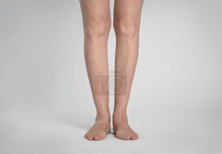 Photo for Closeup view of woman with varicose veins on light background - Royalty Free Image