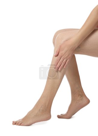 Photo for Closeup view of woman with varicose veins on white background - Royalty Free Image