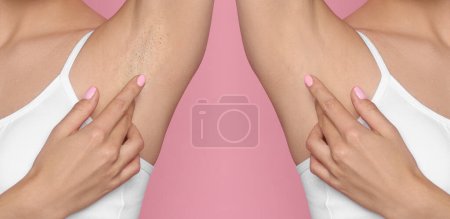 Foto de Antes y después de la depilación. Collage con fotos de mujer mostrando axila sobre fondo rosa, primer plano - Imagen libre de derechos