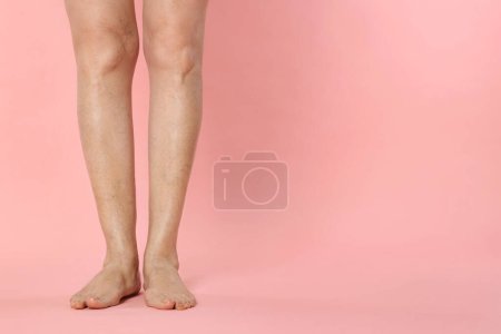 Photo for Closeup view of woman with varicose veins on pink background. Space for text - Royalty Free Image