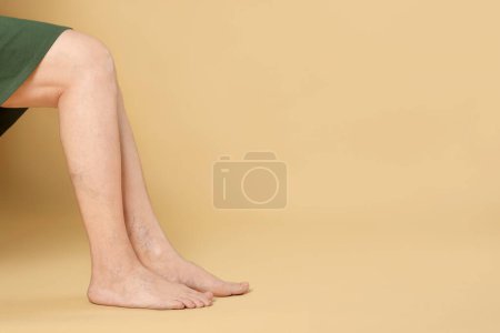 Photo for Closeup view of woman with varicose veins on yellow background. Space for text - Royalty Free Image