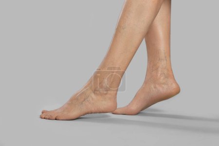 Closeup view of woman with varicose veins on light grey background