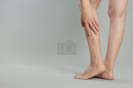 Photo for Closeup view of woman suffering from varicose veins on light grey background. Space for text - Royalty Free Image