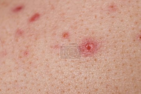 Junge Person mit Akne-Problem, Nahaufnahme der Haut