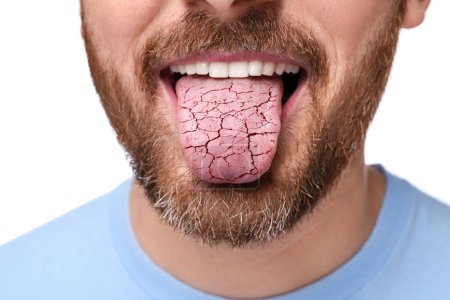 Foto de Síntoma de boca seca. Hombre mostrando lengua deshidratada sobre fondo blanco, primer plano - Imagen libre de derechos
