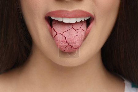Síntoma de boca seca. Mujer mostrando lengua deshidratada, primer plano