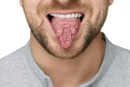 Foto de Síntoma de boca seca. Hombre mostrando lengua deshidratada sobre fondo blanco, primer plano - Imagen libre de derechos