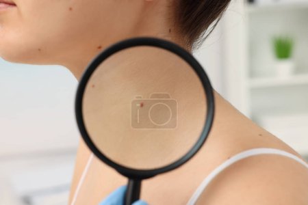 Photo for Dermatologist examining patient's birthmark with magnifying glass indoors, closeup - Royalty Free Image