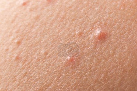 Téléchargez les photos : Jeune avec problème d'acné, vue rapprochée de la peau - en image libre de droit