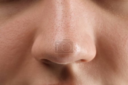 Téléchargez les photos : Jeune femme avec problème d'acné, vue rapprochée - en image libre de droit