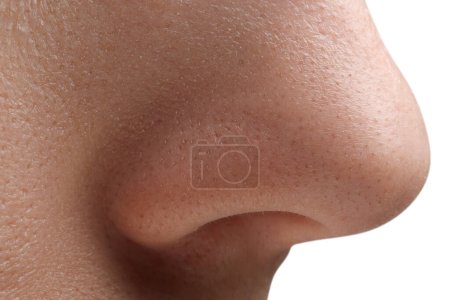 Junge Frau mit Akne-Problem auf weißem Hintergrund, Nahaufnahme der Nase