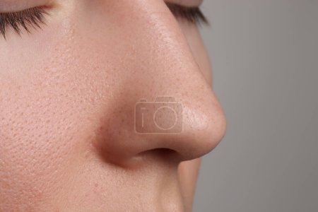 Téléchargez les photos : Jeune femme avec problème d'acné sur fond gris, vue rapprochée du nez. Espace pour le texte - en image libre de droit