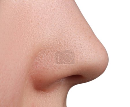 Téléchargez les photos : Jeune femme avec problème d'acné sur fond blanc, vue rapprochée du nez - en image libre de droit