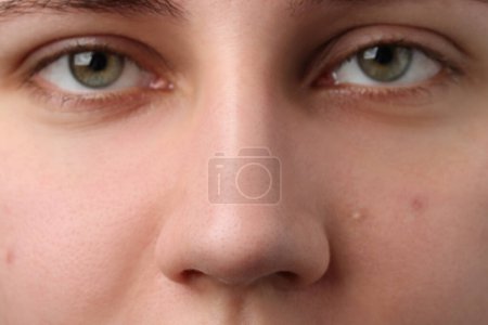 Téléchargez les photos : Jeune femme avec problème d'acné, vue rapprochée - en image libre de droit