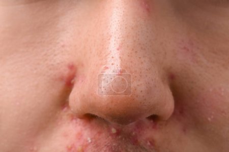 Junger Mann mit Akne-Problem, Nahaufnahme der Nase