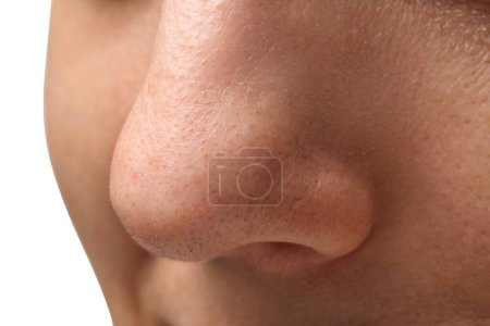 Téléchargez les photos : Jeune femme avec problème d'acné sur fond blanc, vue rapprochée du nez - en image libre de droit