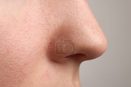 Téléchargez les photos : Jeune femme avec problème d'acné sur fond gris, vue rapprochée du nez - en image libre de droit