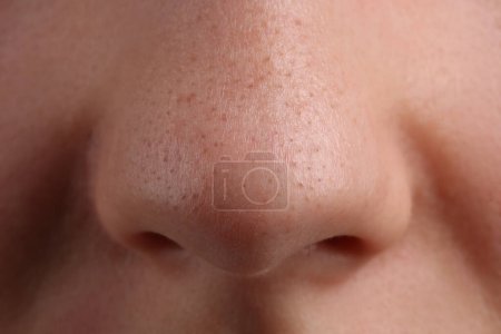 Mujer joven con problemas de acné, vista de cerca de la nariz