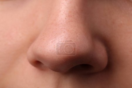 Téléchargez les photos : Jeune femme avec problème d'acné, vue rapprochée du nez - en image libre de droit