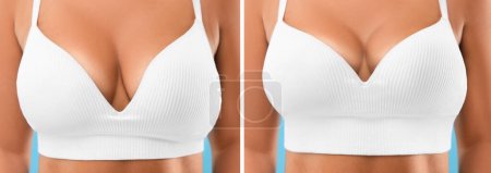 Téléchargez les photos : Collage avec des photos de la femme avant et après la chirurgie mammaire, gros plan - en image libre de droit