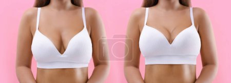 Collage con fotos de la mujer antes y después de la cirugía de levantamiento de senos sobre fondo rosa, primer plano