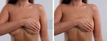 Téléchargez les photos : Collage avec des photos de la femme avant et après chirurgie mammaire sur fond gris clair, gros plan - en image libre de droit
