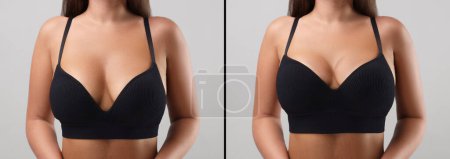 Téléchargez les photos : Collage avec des photos de la femme avant et après chirurgie mammaire sur fond gris clair, gros plan - en image libre de droit
