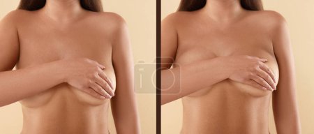 Téléchargez les photos : Collage avec des photos de la femme avant et après chirurgie mammaire sur fond beige, gros plan - en image libre de droit