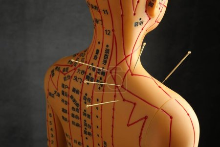 Foto de Acupuntura - medicina alternativa. Modelo humano con agujas en hombro sobre fondo gris oscuro - Imagen libre de derechos