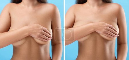 Collage with photos of woman before and after breast-lift surgery on light blue background, closeup