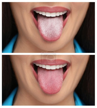 Téléchargez les photos : Collage avec photos de la femme avant et après le nettoyage de la langue, gros plan - en image libre de droit