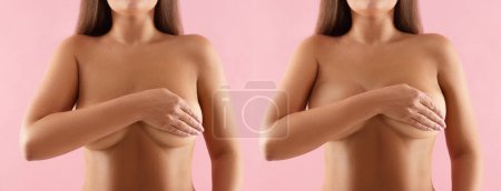 Téléchargez les photos : Collage avec des photos de la femme avant et après chirurgie mammaire sur fond rose, gros plan - en image libre de droit