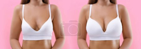 Téléchargez les photos : Femme avant et après l'augmentation mammaire sur fond rose, gros plan. Collage avec photos montrant la différence entre les tailles de seins - en image libre de droit