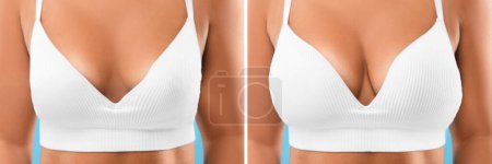 Téléchargez les photos : Femme avant et après l'augmentation mammaire, gros plan. Collage avec photos montrant la différence entre les tailles de seins - en image libre de droit