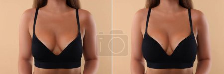 Téléchargez les photos : Femme avant et après augmentation mammaire sur fond beige, gros plan. Collage avec photos montrant la différence entre les tailles de seins - en image libre de droit