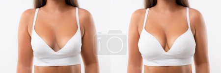 Téléchargez les photos : Femme avant et après l'augmentation mammaire sur fond clair, gros plan. Collage avec photos montrant la différence entre les tailles de seins - en image libre de droit