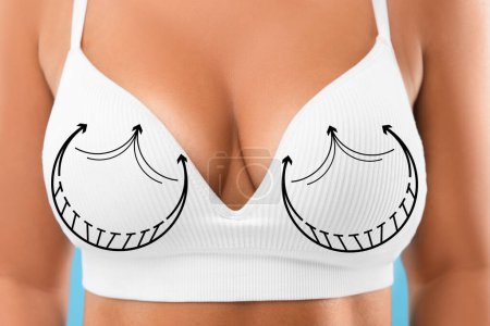Téléchargez les photos : Chirurgie mammaire. Femme avec des marques sur le soutien-gorge, gros plan - en image libre de droit
