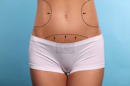 Photo for Woman with markings for cosmetic surgery on her abdomen against light blue background, closeup - Royalty Free Image