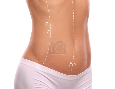 Foto de Mujer con marcas para cirugía estética en su abdomen sobre fondo blanco, primer plano - Imagen libre de derechos