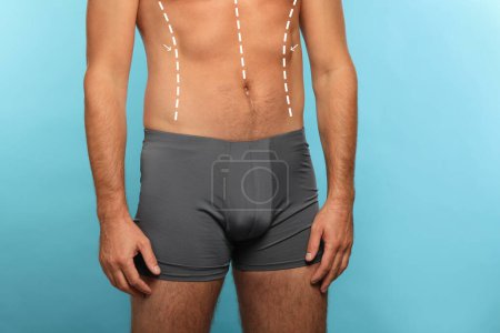 Photo for Man with markings for cosmetic surgery on his abdomen against light blue background, closeup - Royalty Free Image