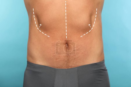 Foto de Hombre con marcas para cirugía estética en su abdomen contra fondo azul claro, primer plano - Imagen libre de derechos