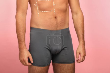 Photo for Man with markings for cosmetic surgery on his abdomen against pink background, closeup - Royalty Free Image