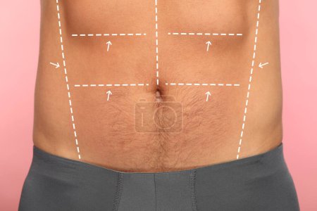 Foto de Hombre con marcas para la cirugía estética en su abdomen contra el fondo rosa, primer plano - Imagen libre de derechos