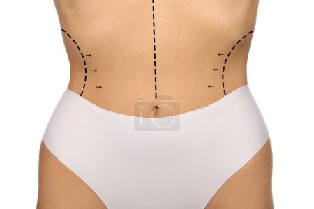 Foto de Mujer con marcas para cirugía estética en su abdomen sobre fondo blanco, primer plano - Imagen libre de derechos