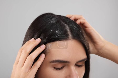 Téléchargez les photos : Femme examinant ses cheveux et son cuir chevelu sur fond gris, gros plan. Problème de pellicules - en image libre de droit