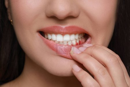 Frau zeigt entzündetes Zahnfleisch, Nahaufnahme. Mundhöhlengesundheit