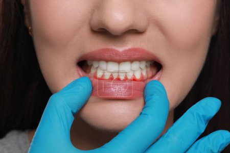 Arzt untersucht entzündetes Zahnfleisch der Frau, Nahaufnahme. Mundhöhlengesundheit