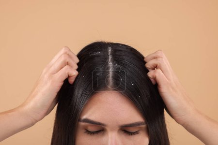 Téléchargez les photos : Femme examinant ses cheveux et son cuir chevelu sur fond beige, gros plan. Problème de pellicules - en image libre de droit