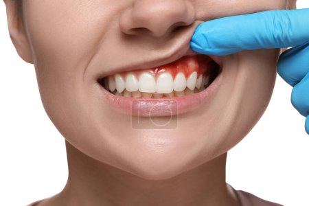 Arzt untersucht entzündetes Zahnfleisch der Frau auf weißem Hintergrund, Nahaufnahme